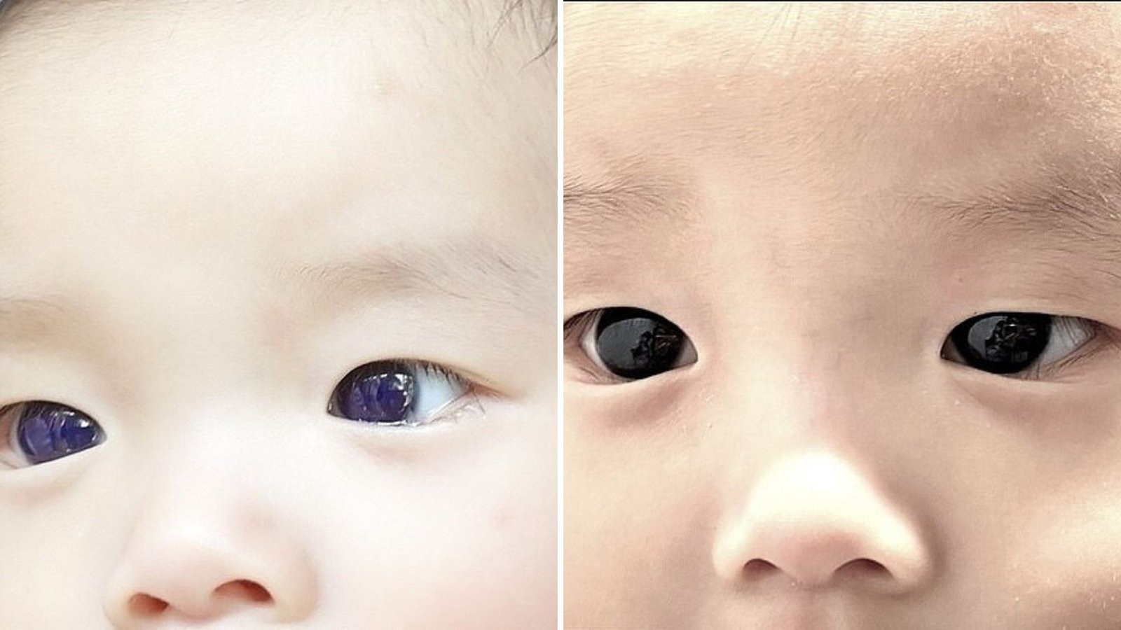 Strange Reaction: Six-Month-Old’s Eyes Turn Bright Blue After Covid Treatment