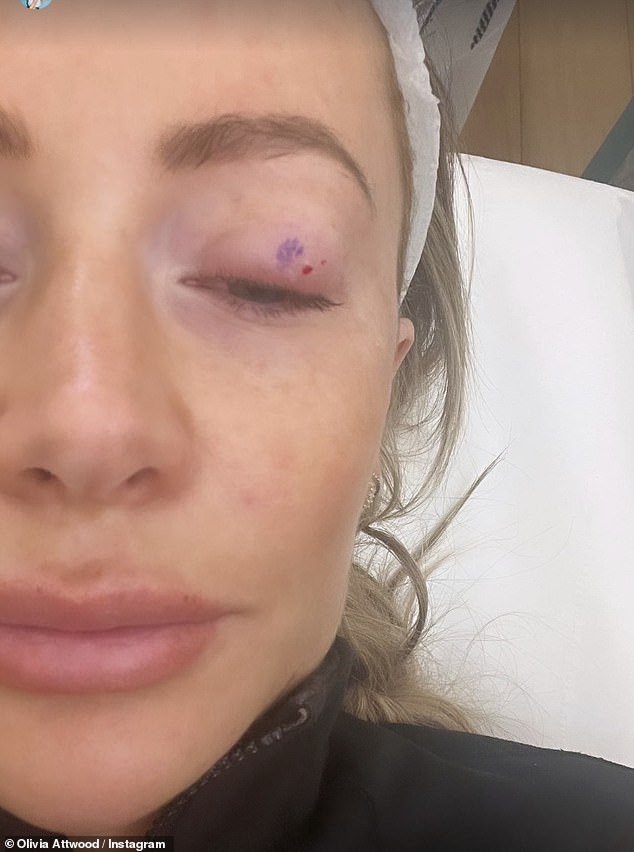 Olivia Attwood Provides Health Update Following Medical Emergency, Reveals Details of ‘Graphic’ Operation