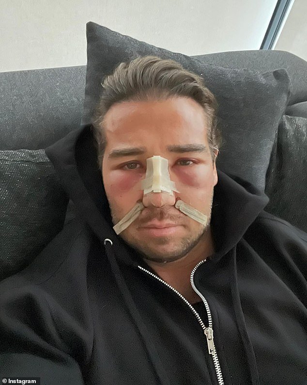 TOWIE Star James Lock Reveals Post-Surgery Photos of His 