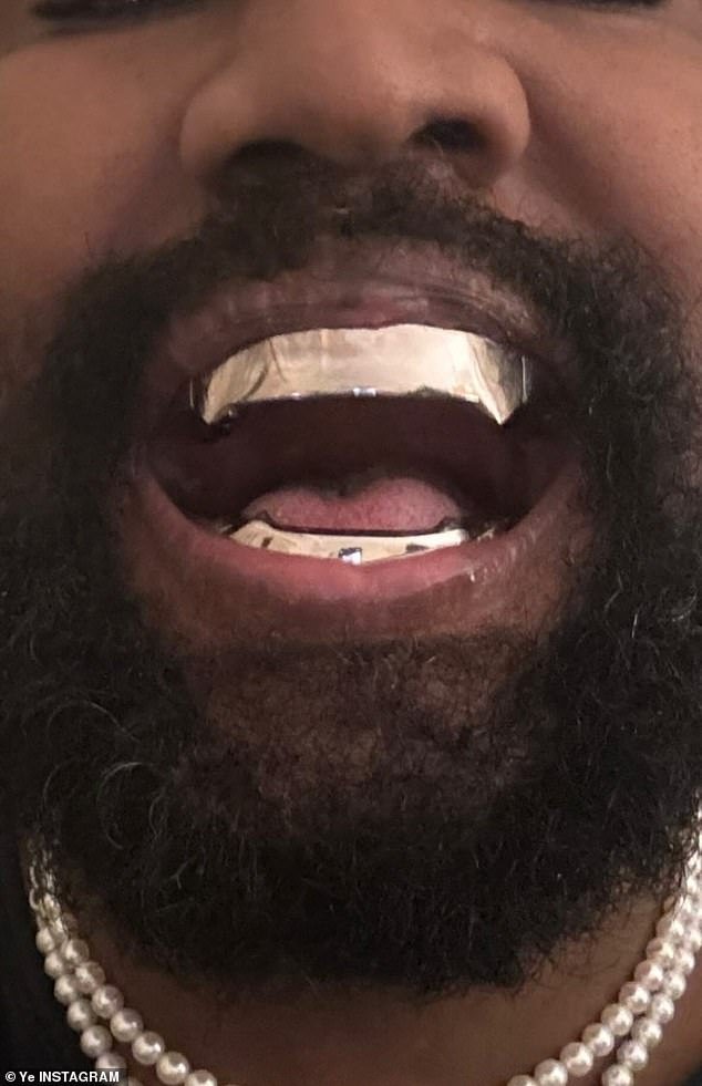 Celebrities Sporting Outrageous Grills: Joining Kanye West’s Titanium Denture Trend